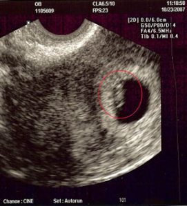 ultrasound of early embryo